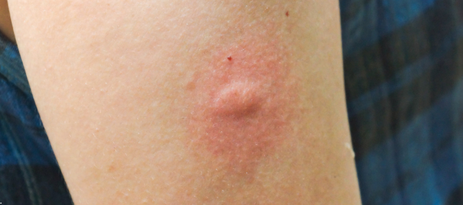 a mosquito bite on skin
